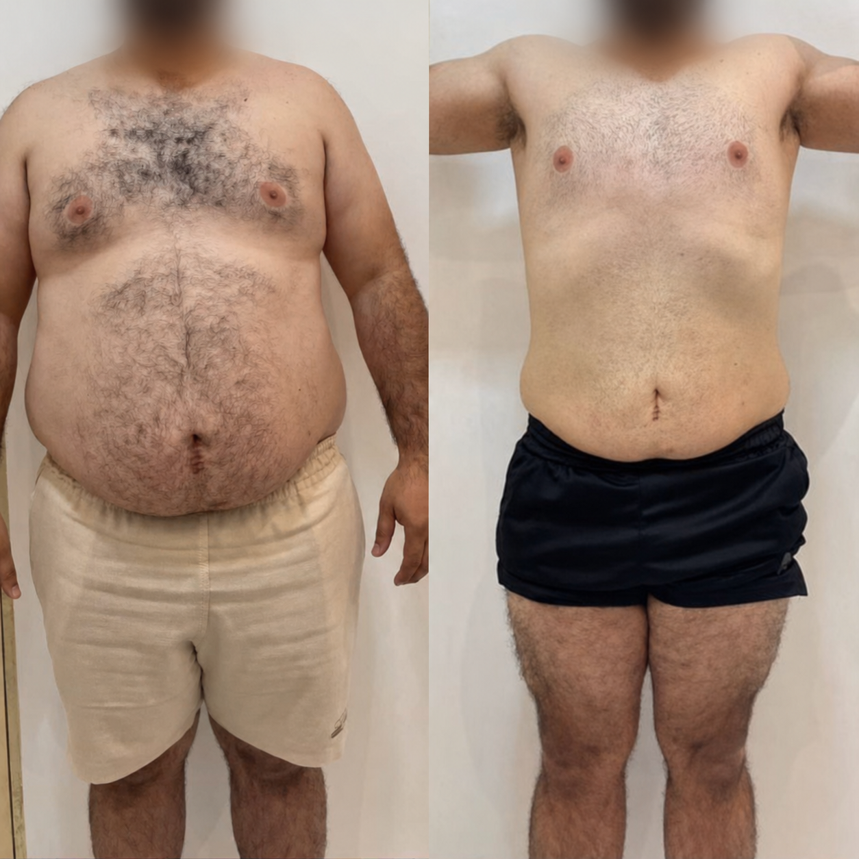 Comparativo corporal anonimizado de paciente 4